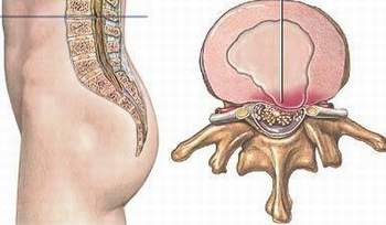 Đau từ mông xuống đầu gối