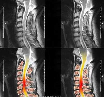 Đừng xem thường bệnh đau vai gáy