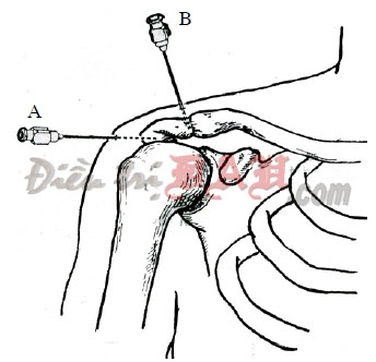 Acromioclavicular Joint Injection