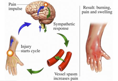 Hội chứng đau vùng phức hợp: chứng đau bí ẩn