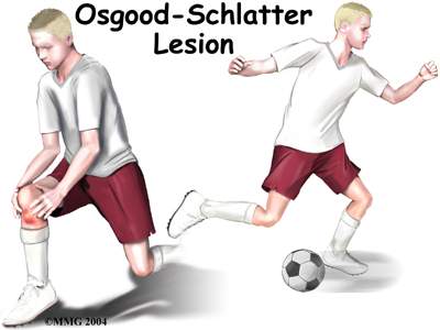 Bạn biết gì về bệnh Osgood- Schlatter?