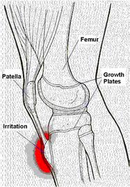 Bạn biết gì về bệnh Osgood- Schlatter?