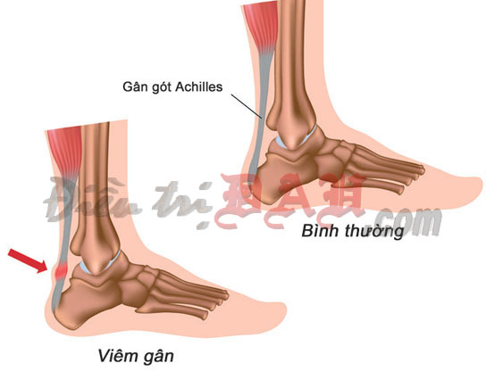 Thoái hóa gân Achilles