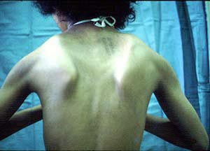 Loạn dưỡng cơ Duchenne