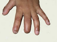 Nhận biết sớm bệnh gút bẩm sinh