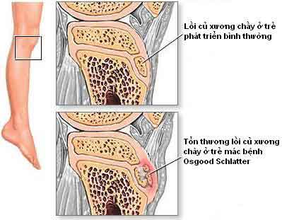 Tổn thương trong bệnh sưng đau lồi củ trước xương chày