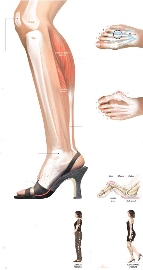 Những tác hại của giày cao gót với cơ thể