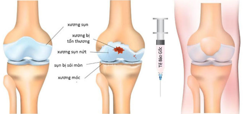Tiêm tế bào gốc trị thoái hóa khớp gối