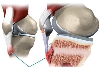 Bệnh cơ – xương – khớp hay gặp ở tuổi thiếu niên