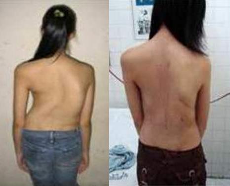 Hình ảnh cong vẹo cột sống của một bệnh nhân nữ trước và sau khi mổ