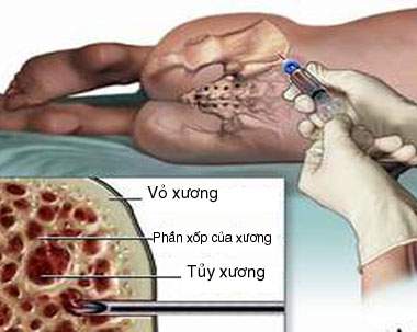 Điều trị viêm xương tủy nhiễm khuẩn