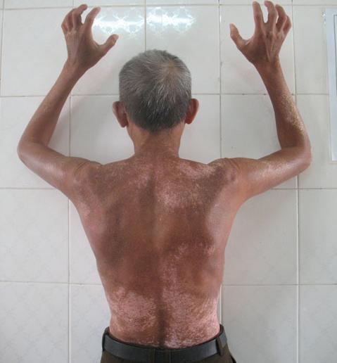 Toàn thân đau nhức vì chứng xơ cứng bì
