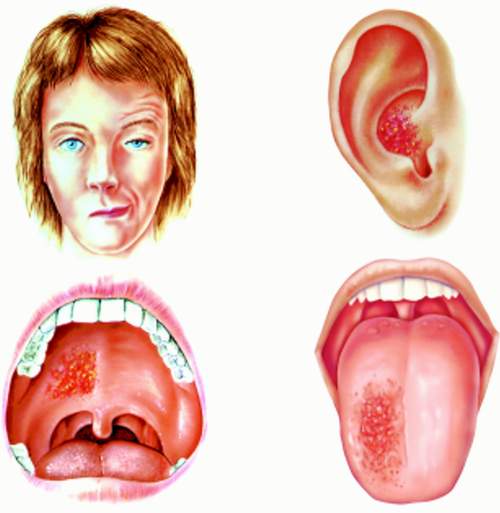 Các vị trí tổn thương trong hội chứng Ramsay Hunt