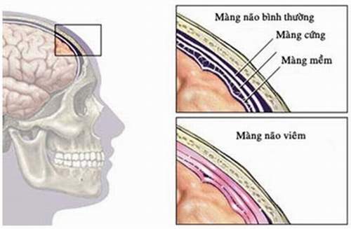 Lao màng não dễ bị bỏ qua, vì sao?