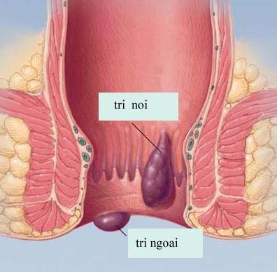 Liệu pháp tối ưu cho người bệnh trĩ