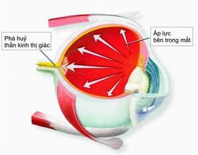 Phát hiện sớm bệnh glôcôm: Một giải pháp ngăn chặn mù lòa
