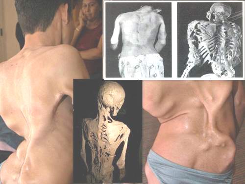 Hội chứng người hóa đá
