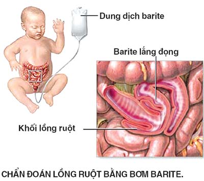 Viêm ruột thừa cấp tính
