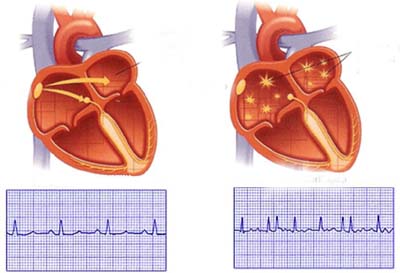 Viêm khớp dạng thấp làm tăng nguy cơ rối loạn nhịp tim