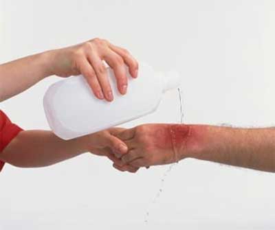 Đau đớn chuyện dùng muối, đá lạnh, nước… chữa bỏng