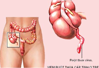 Viêm ruột hoại tử